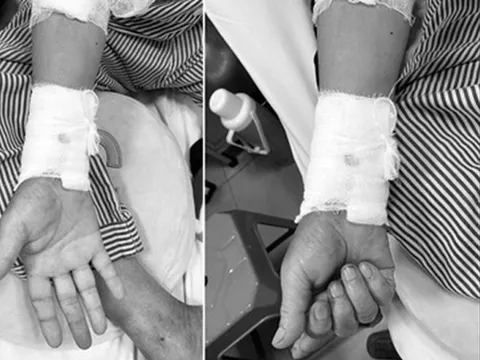 Ngủ dậy bất ngờ tê bì, đau nhức tay, người đàn ông gặp nguy hiểm, suýt phải cắt bỏ bàn tay