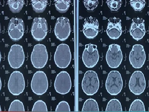 Người đàn ông bị đột quỵ khi tập thể dục lúc sáng sớm