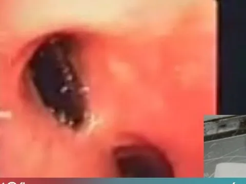 Nhập viện vì khó thở, đau tức ngực, bác sĩ phát hiện "thủ phạm" là hạt hồng xiêm nằm chắn ngang lòng phế quản