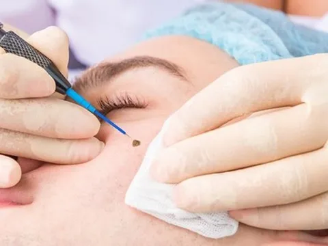 Xóa nốt ruồi cần lưu ý điều gì?