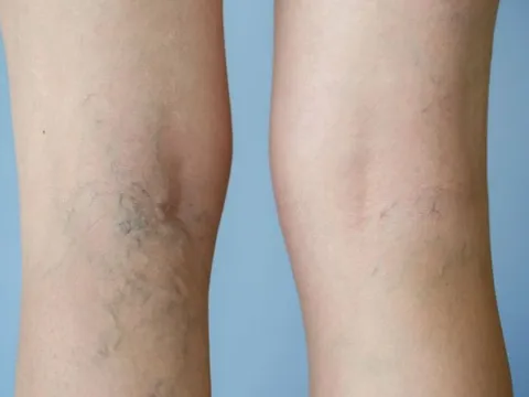 Người đàn ông nguy cơ tàn phế do hút thuốc nhiều năm