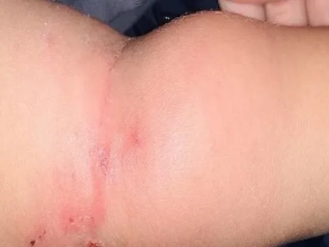 Bé 2 tuổi nhiễm trùng máu từ vết muỗi đốt