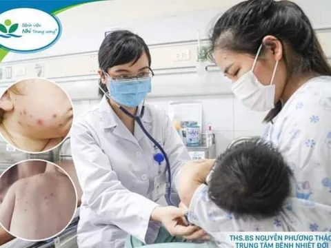 Thủy đậu bùng phát mạnh, 5 điều mọi người cần biết để tránh biến chứng nặng