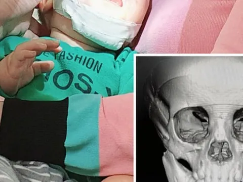 Bé 10 tháng tuổi gãy xương hàm dưới do ngã xe đẩy