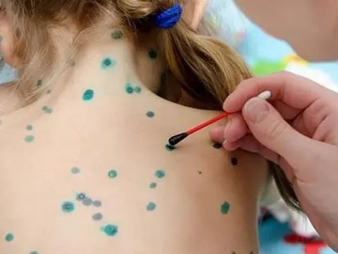 Bệnh thủy đậu bùng phát mạnh tại Hà Nội, sắp chạm ngưỡng 1.000 ca: Làm gì để phòng tránh?