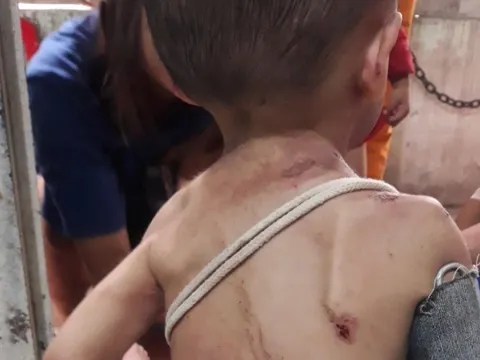 Thông tin mới về sức khỏe bé trai ở Tp.HCM có dấu hiệu bị bạo hành