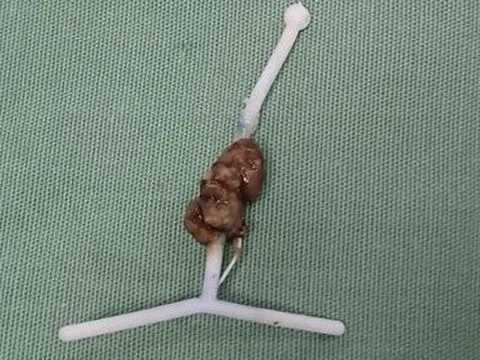 Nội soi ngược dòng tán sỏi cho bệnh nhân bị biến chứng hiếm gặp khi đặt vòng tránh thai