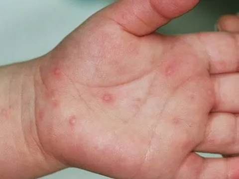 Tay chân miệng gia tăng tại Hà Nội: Phòng tránh thế nào?