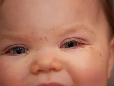 Triệu chứng mới của COVID-19 xuất hiện ở mắt