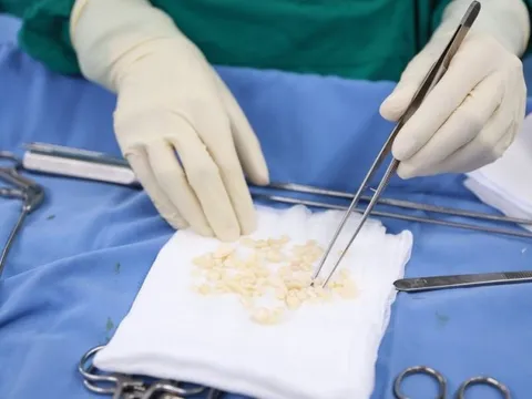 Lấy 100 viên sỏi trong khớp gối một người phụ nữ