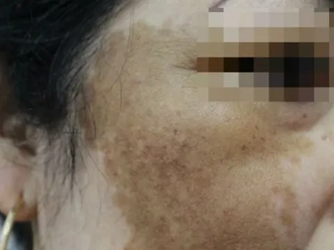 Hà Nội: Chi 60 triệu chữa nám người phụ nữ nhận kết đắng