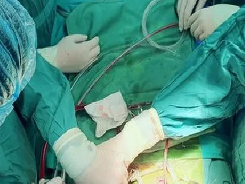 Cứu bé sơ sinh trải qua 4 lần đại phẫu trong 20 ngày đầu đời