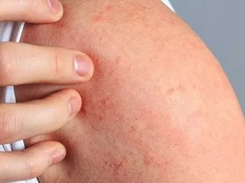 Nghe lời mách đốt vỏ tôm uống chữa dị ứng, cô gái uống xong ngất xỉu