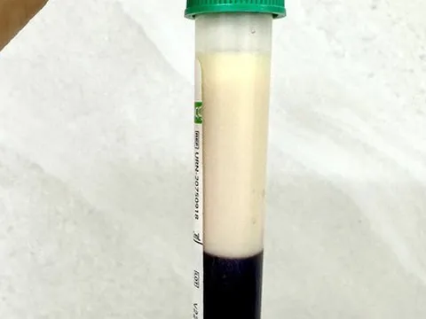 Uống thuốc giảm cân, trong máu người phụ nữ có lớp mỡ trắng đục như sữa