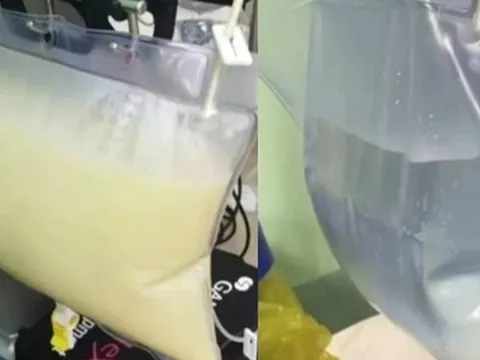 Máu của chàng trai 26 tuổi đục như sữa và nhớt như xăng, suýt mất mạng vì sở thích ăn uống không hiếm gặp ở người trẻ tuổi