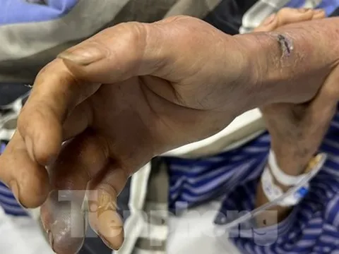 Nhiều người bị rắn độc tấn công ở Lạng Sơn