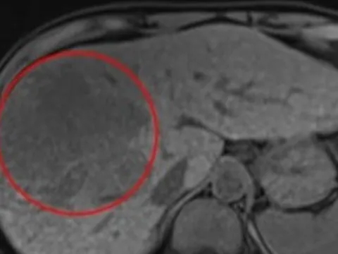 Phù chân, đau hạ sườn, mệt mỏi, đi khám phát hiện mắc ung thư giai đoạn cuối