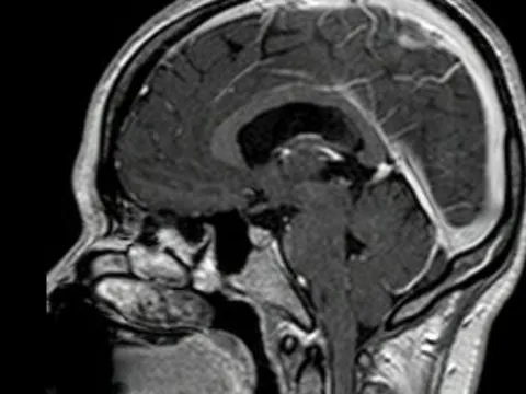 Bệnh viện Vũng Tàu điều trị kịp thời bệnh nhân bị tắc tĩnh mạch não