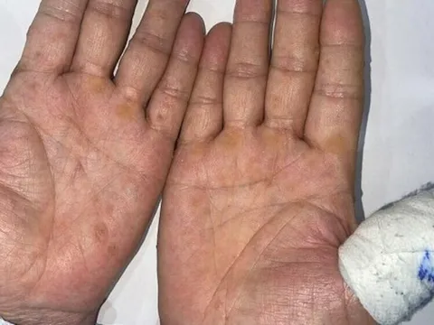 Xuất hiện lốm đốm trên da, người đàn ông đi khám phát hiện mắc ung thư vì dùng một thứ lâu năm