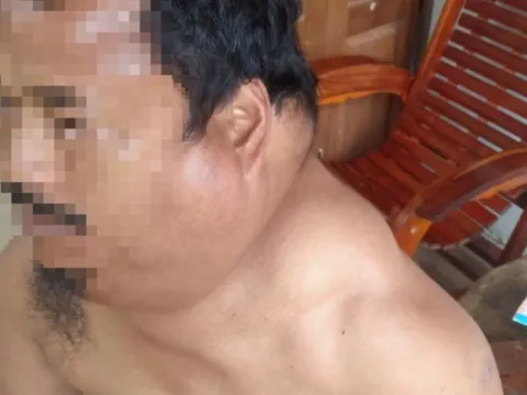 Đà Nẵng: Phẫu thuật lấy 4 kg mỡ của người đàn ông bị bệnh lạ hiếm gặp