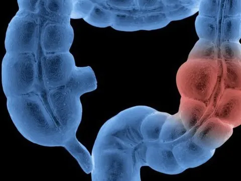 Nữ y tá 24 tuổi phát hiện ung thư đại tràng giai đoạn 3 từ 1 triệu chứng