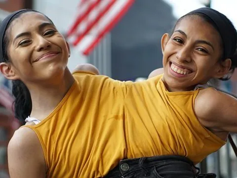 Cuộc sống của cặp song sinh dính liền