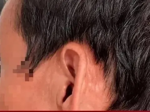 Hàng chục con giòi làm tổ trong tai người đàn ông ở Quảng Trị