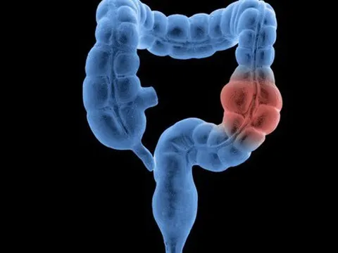 Bốn dấu hiệu hàng đầu báo động ung thư ruột xuất hiện