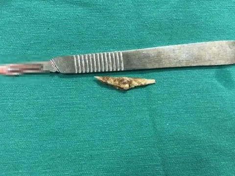 Bị đau bụng nhiều năm do hóc xương mà không biết