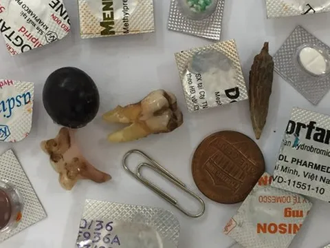 Bác sĩ nội soi sửng sốt vì một đống rác hỗn độn trong bao tử nam thanh niên