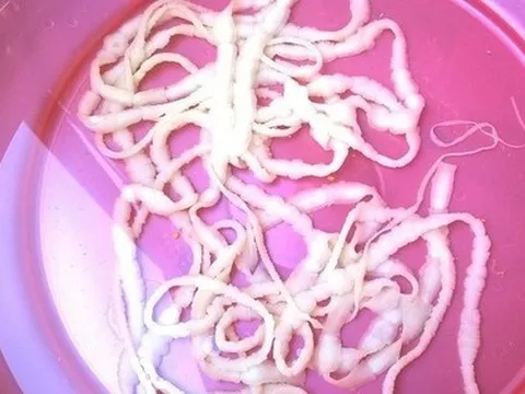 Phát hiện sán xơ mít dài hơn 3m ký sinh trong cơ thể cháu bé 10 tuổi