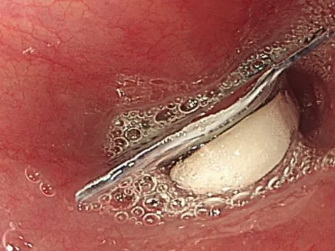 Nhiều trường hợp nuốt nhầm dị vật: Bác sĩ đưa ra lời cảnh báo