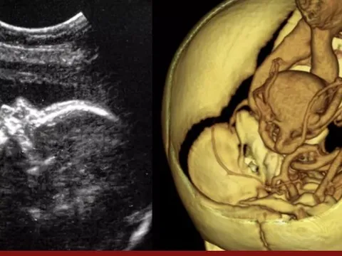 Ca phẫu thuật não đầu tiên trên thai nhi trong bụng mẹ được thực hiện