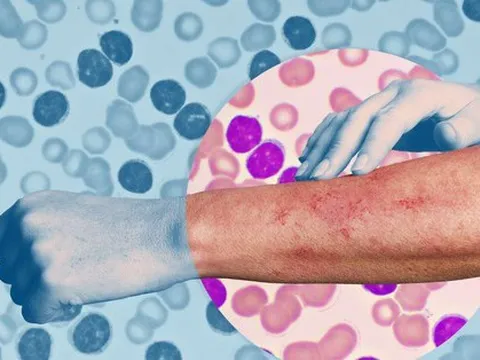 Những dấu hiệu lạ kỳ trên da cảnh báo ung thư máu đang ‘gõ cửa’