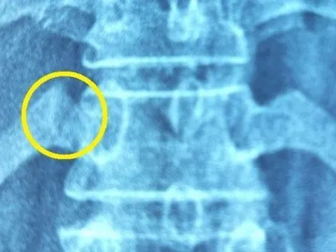 Bị gãy xương sườn vì đi bấm huyệt, bẻ khớp