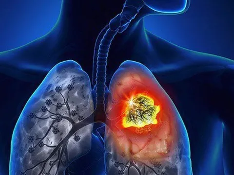 Hàng chục nghìn ca ung thư phổi mỗi năm, người trẻ mắc ngày càng nhiều