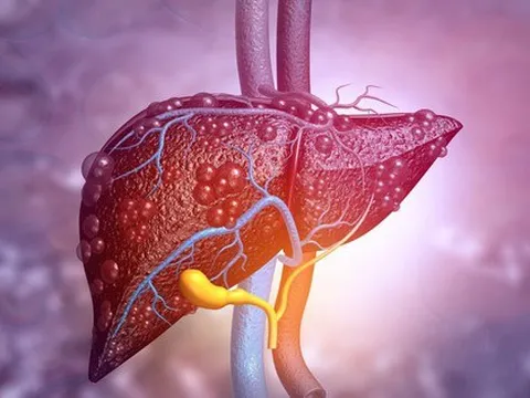 Khi gan suy yếu, cơ thể thường xuất hiện 10 dấu hiệu bất thường, rất dễ bị bỏ qua