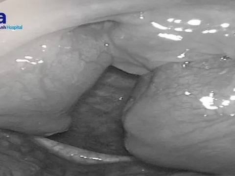 20 năm "ngáy sấm" vì khối amidan to như trứng gà