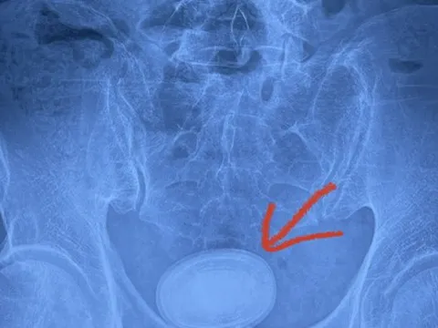 Người đàn ông có viên sỏi kích thước 6cm trong bàng quang