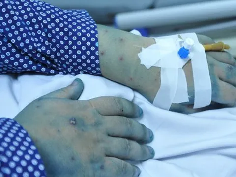 5 biến chứng nguy hiểm của bệnh thủy đậu, có thể gây tử vong nhưng ít người biết