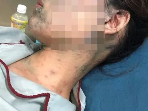 Mắc thủy đậu bội nhiễm, thai phụ 22 tuần phải nhập viện khẩn