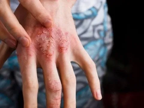 Không chịu tẩy giun suốt nhiều năm, người đàn ông mắc bệnh hiếm gặp