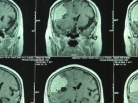 Đi khám đau đầu, phát hiện khối u màng não to hơn trứng vịt