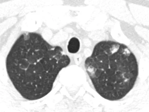 Không tẩy giun nhiều năm, người đàn ông bị sốt, tức ngực do mắc hội chứng ít ai biết