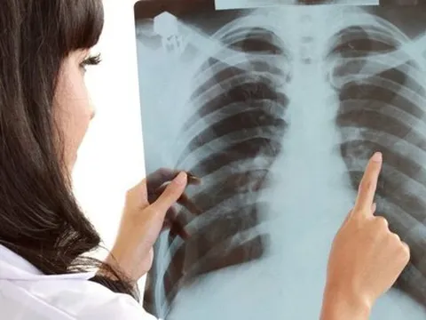 Nữ giáo viên sốc khi phát hiện mắc ung thư phổi, chia sẻ 3 dấu hiệu đã trải qua