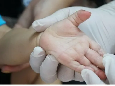 Một bệnh nhi ở Đắk Lắk tử vong vì tay chân miệng