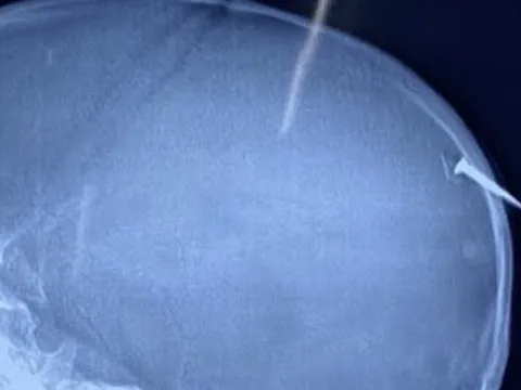 Phẫu thuật kịp thời cho bé trai bị cây đinh dài 3cm đâm qua xương sọ