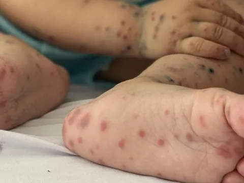 Nhiều trẻ mắc tay chân miệng trở nặng: Chuyên gia dự đoán số ca sẽ tăng cao