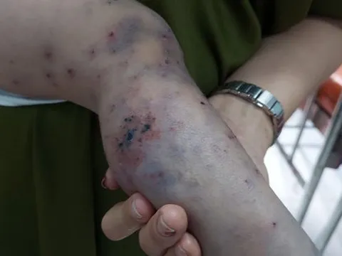 TP HCM: Một ca tử vong vì bệnh tay chân miệng