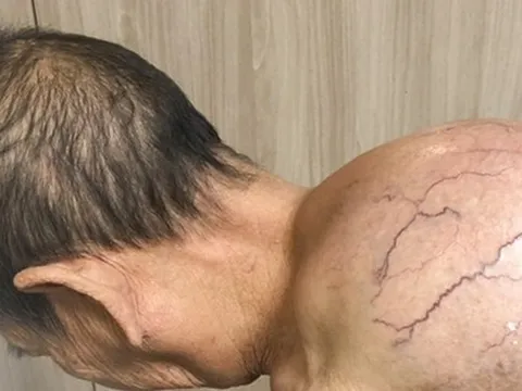 Phẫu thuật cắt bỏ thành công khối u 'khổng lồ' trên lưng cụ bà 95 tuổi